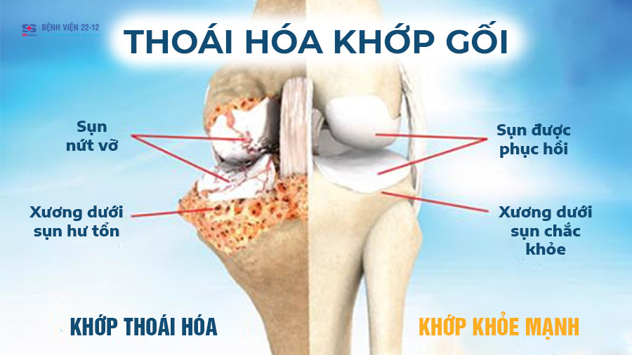 Thoái hóa khớp gối nguyên phát nghe có vẻ phức tạp, nhưng thực ra lại rất gần gũi với cuộc sống hàng