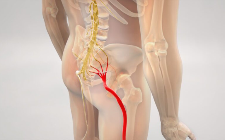 Cần xác định nguyên nhân gây đau dây thần kinh tọa để có phác đồ điều trị toàn diện nhất