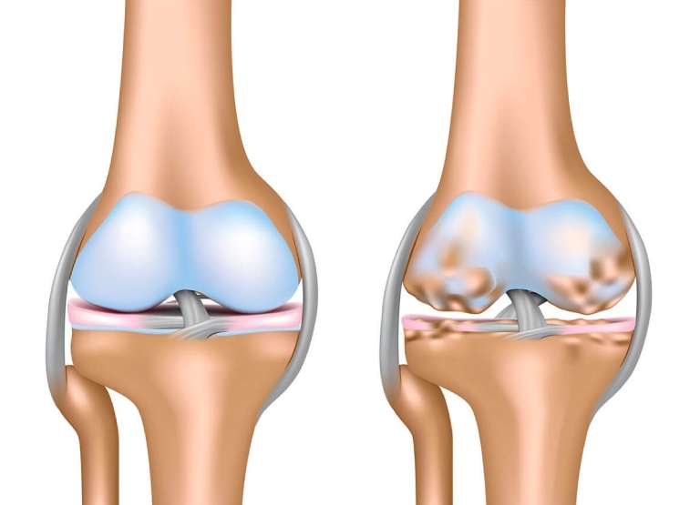 Thoái hóa khớp cần được điều trị toàn diện để cải thiện sức khỏe xương khớp một cách tốt nhất