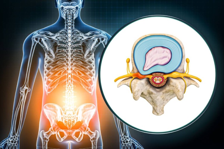 Thoát vị đĩa đệm cần điều trị toàn diện để duy trì hiệu quả bền vững, ngăn ngừa tái phát