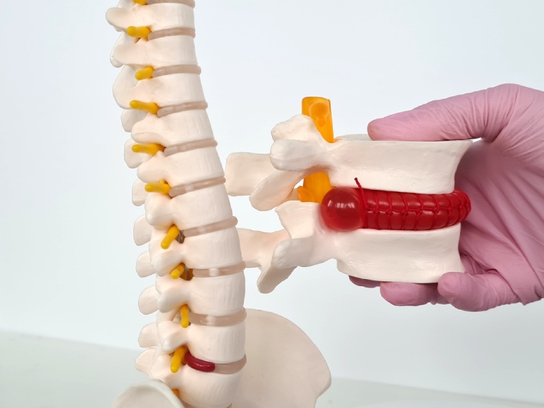 Thoát vị đĩa đệm gây ra những ảnh hưởng không nhỏ đến chất lượng cuộc sống của mỗi người