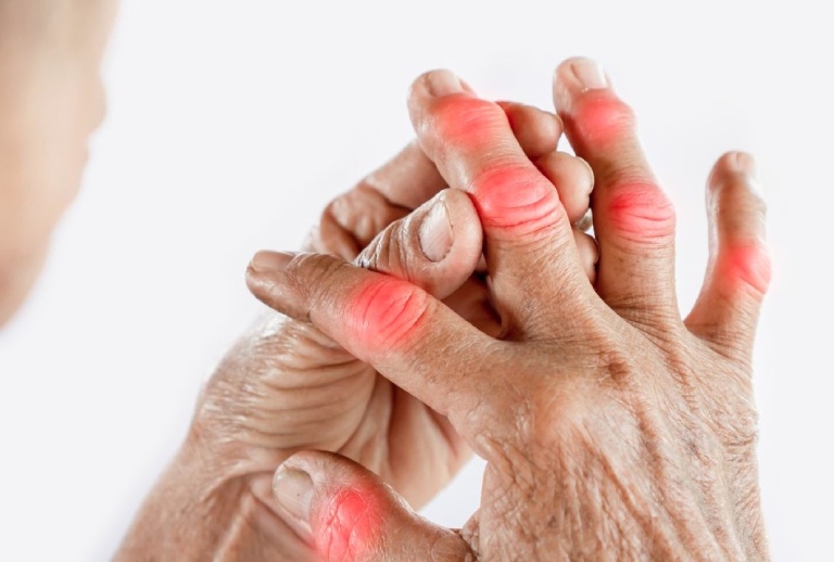 Viêm khớp dạng thấp gây ảnh hưởng nghiêm trọng đến cuộc sống sinh hoạt hàng ngày của người bệnh