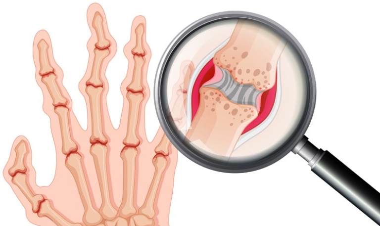 Viêm khớp dạng thấp có thể bắt nguồn từ nhiều nguyên nhân khác nhau