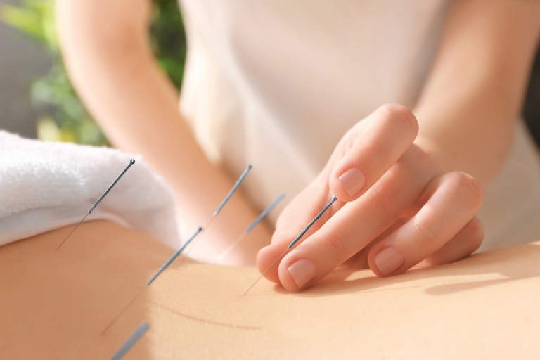 Châm cứu có hiệu quả cải thiện sức khỏe tổng thể một cách tự nhiên