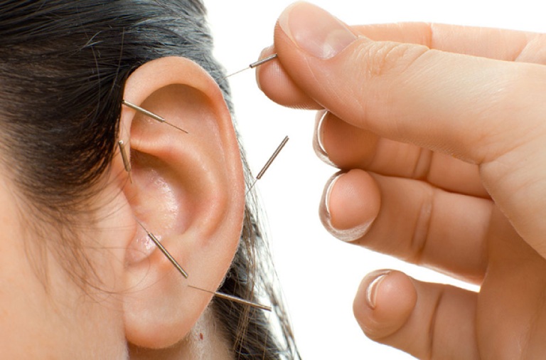 Châm cứu được áp dụng điều trị hiệu quả khá nhiều bệnh lý
