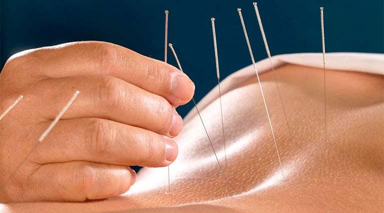 Châm cứu là phương pháp trị liệu quen thuộc trong YHCT