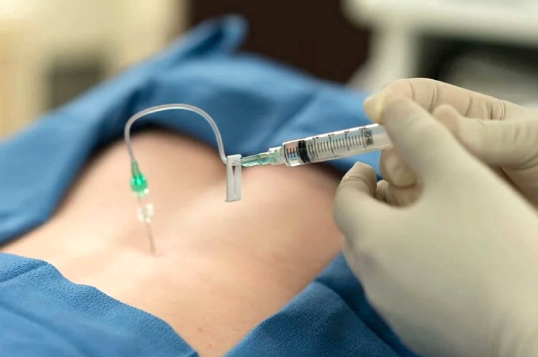Thủy châm là một phương pháp điều trị đặc biệt của YHCT