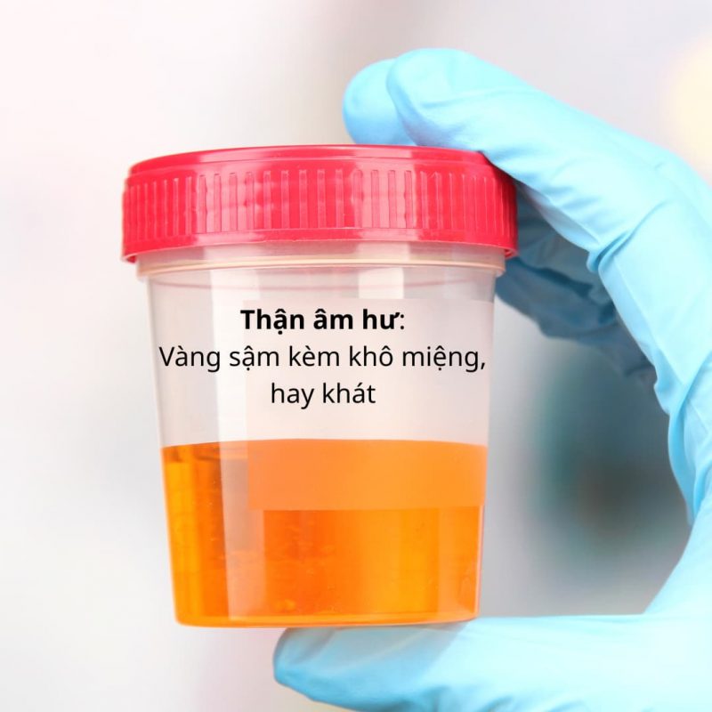 Nước tiểu vàng sậm kèm khô miệng, hay khát