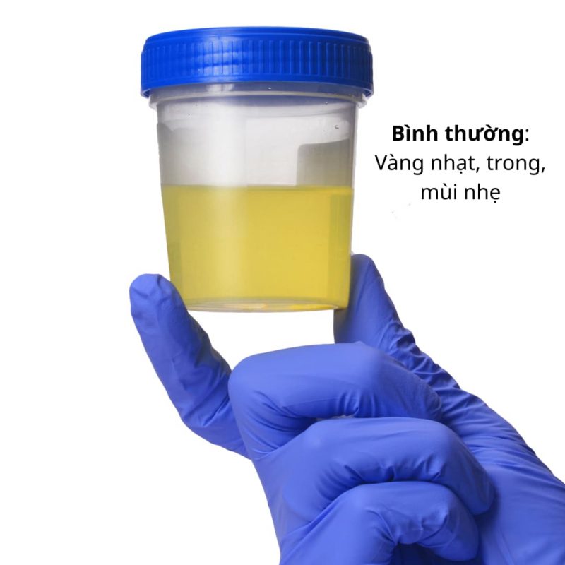 Nước tiểu bình thường - vàng nhạt, trong, mùi nhẹ
