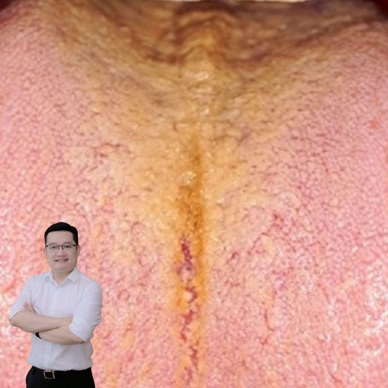 Rêu lưỡi vàng, nhớt