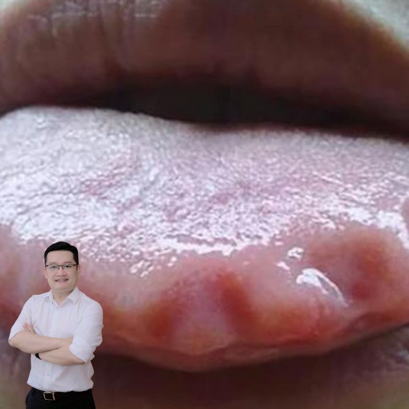Lưỡi có vết hằn răng ở hai bên cạnh